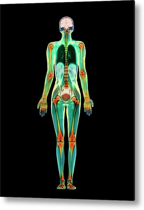 Whole Body Metal Print featuring the photograph Coloured Mri Scan Of A Whole Human Body (female) #2 by Simon Fraser/science Photo Library