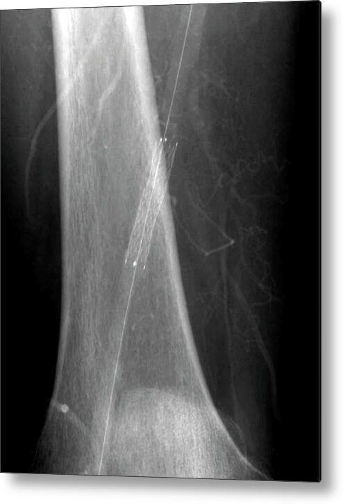 Stenosis Metal Print featuring the photograph Leg Artery Angioplasty #2 by Zephyr/science Photo Library