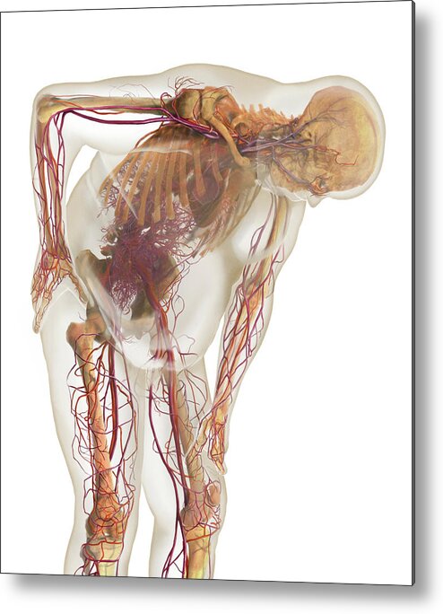3d Visualization Metal Print featuring the photograph Overweight Body And Circulatory System by Anatomical Travelogue