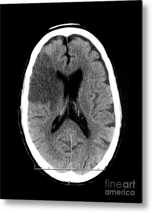 Ct Scan Metal Print featuring the photograph Ct Of Stroke #4 by Medical Body Scans