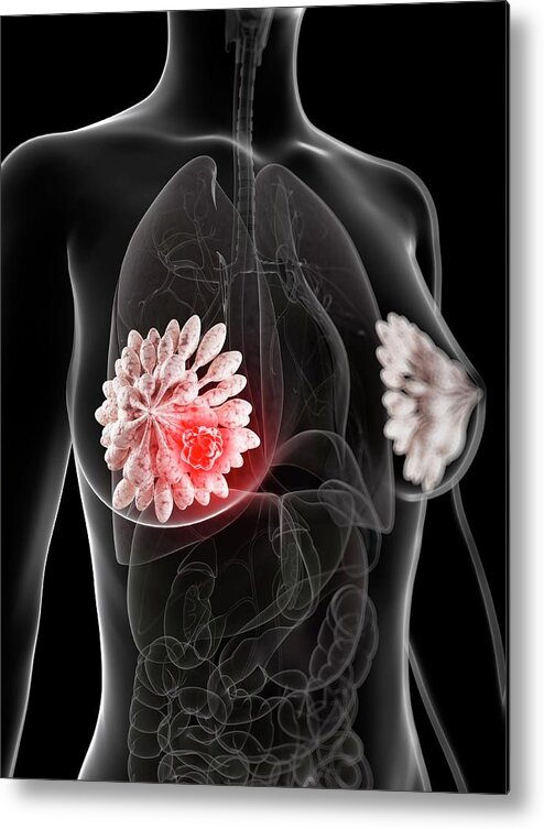 Unhealthy Metal Print featuring the photograph Breast Cancer #24 by Sciepro/science Photo Library