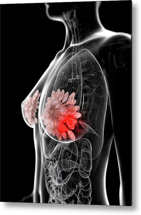 Unhealthy Metal Print featuring the photograph Breast Cancer #29 by Sciepro/science Photo Library