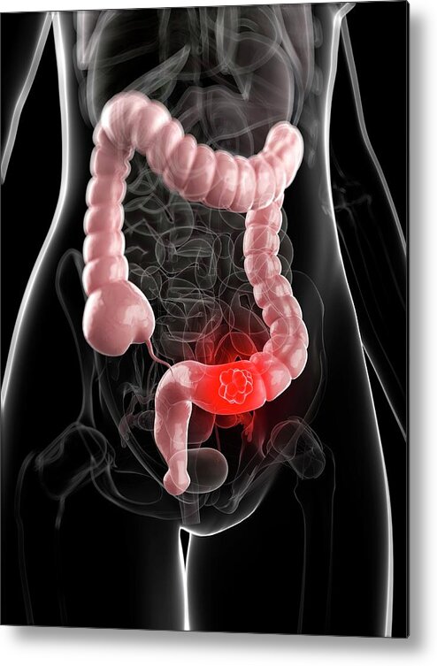 Unhealthy Metal Print featuring the photograph Colon Cancer #6 by Sciepro/science Photo Library