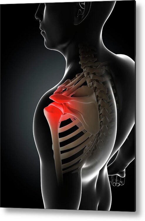 Unhealthy Metal Print featuring the photograph Shoulder Pain #69 by Sciepro/science Photo Library