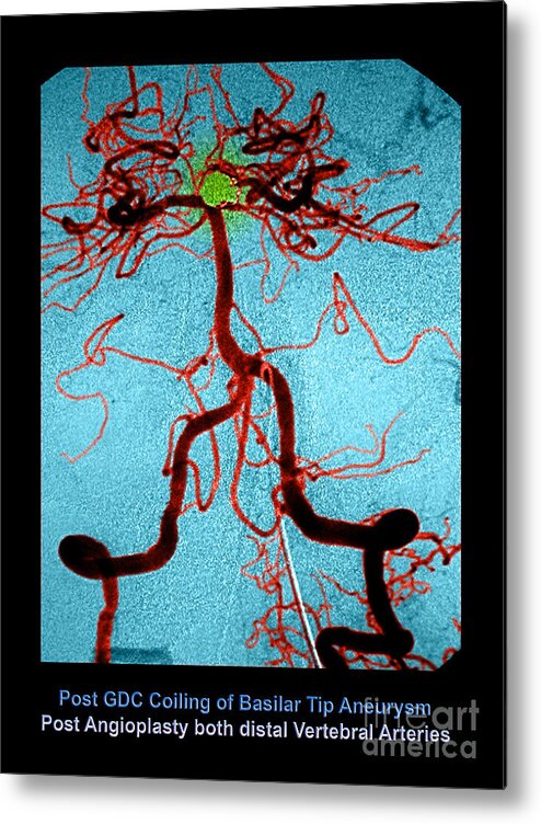 Abnormal Blood Vessel Metal Print featuring the photograph Cerebral Angiogram #2 by Medical Body Scans
