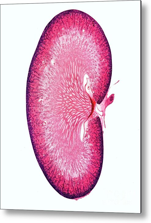 Kidney Metal Print featuring the photograph Kidney #11 by Dr Keith Wheeler/science Photo Library
