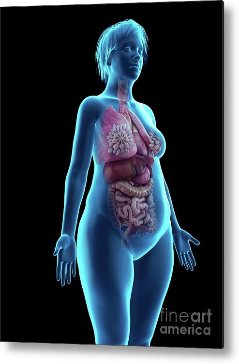 Illustration Of An Obese Woman's Internal Organs #3 Metal Print by