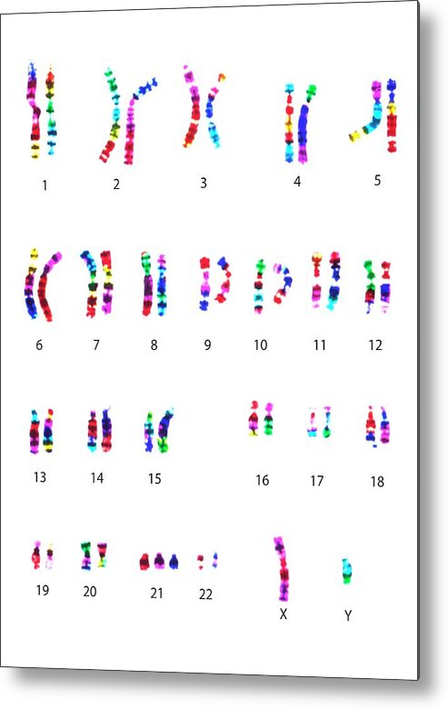 Anomaly Metal Print featuring the photograph Chromosomes In Down's Syndrome #1 by L. Willatt, East Anglian Regional Genetics Service/science Photo Library