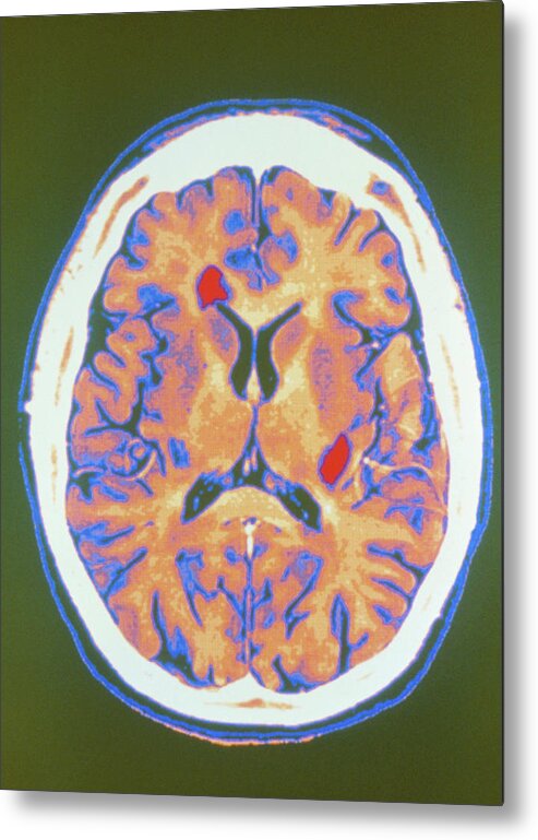Multiple Sclerosis Metal Print featuring the photograph Coloured Mri Scan Of Brain In Multiple Sclerosis by Gca/science Photo Library