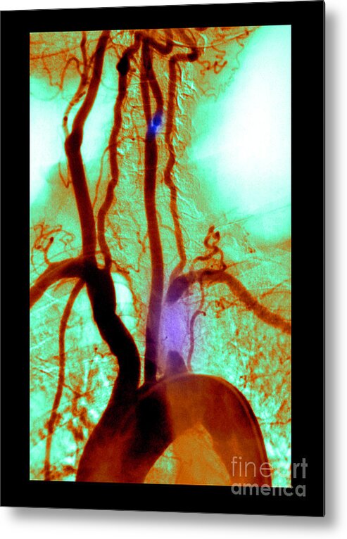 Abnormal Angiogram Metal Print featuring the photograph Aortic Arch Angiogram #1 by Medical Body Scans