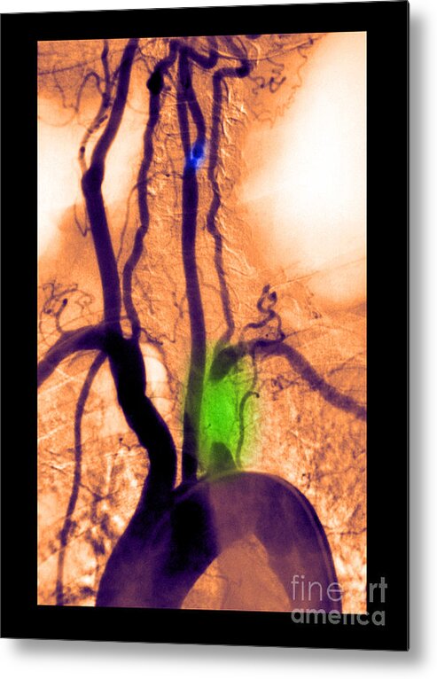 Abnormal Angiogram Metal Print featuring the photograph Aortic Arch Angiogram #2 by Medical Body Scans