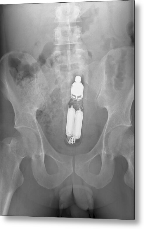 Sex Toy In Man S Rectum X Ray Metal Print By Du Cane Medical Imaging Ltd