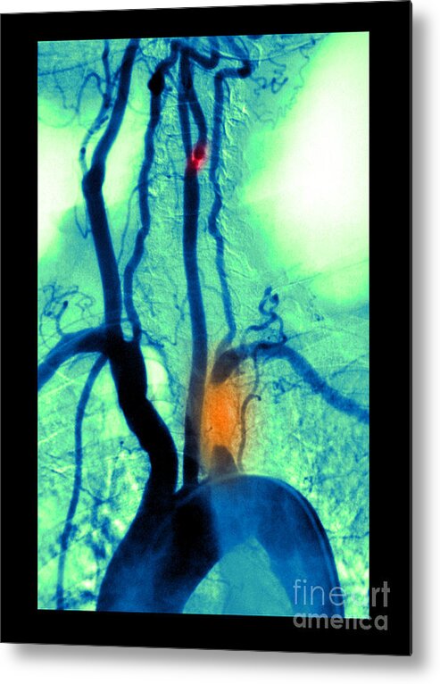 Abnormal Angiogram Metal Print featuring the photograph Aortic Arch Angiogram by Medical Body Scans