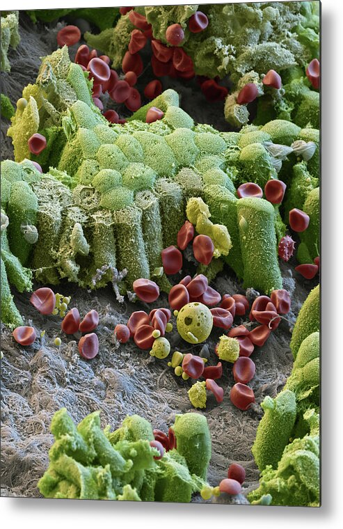 Abnormal Metal Print featuring the photograph Damaged Gallbladder, Sem #3 by Eye of Science