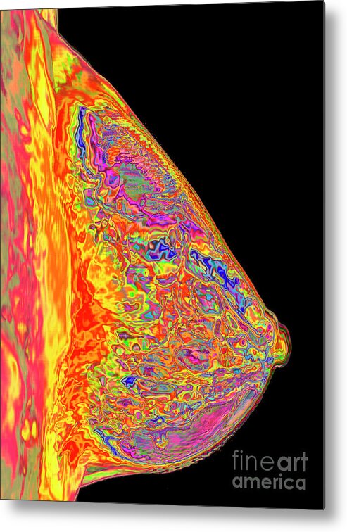 Fibrocystic Breast Disease Metal Print featuring the photograph Fibrocystic Breast Disease by K H Fung/science Photo Library