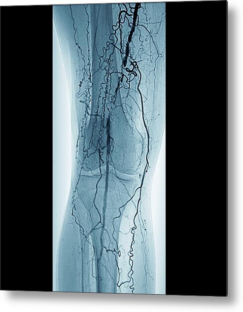 Black Background Metal Print featuring the photograph Peripheral Vascular Disease In Diabetes by Zephyr/science Photo Library