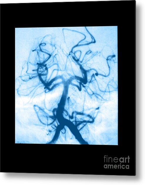 Abnormal Cerebral Angiogram Metal Print featuring the photograph Angiogram Of Embolus In Cerebral Artery by Medical Body Scans