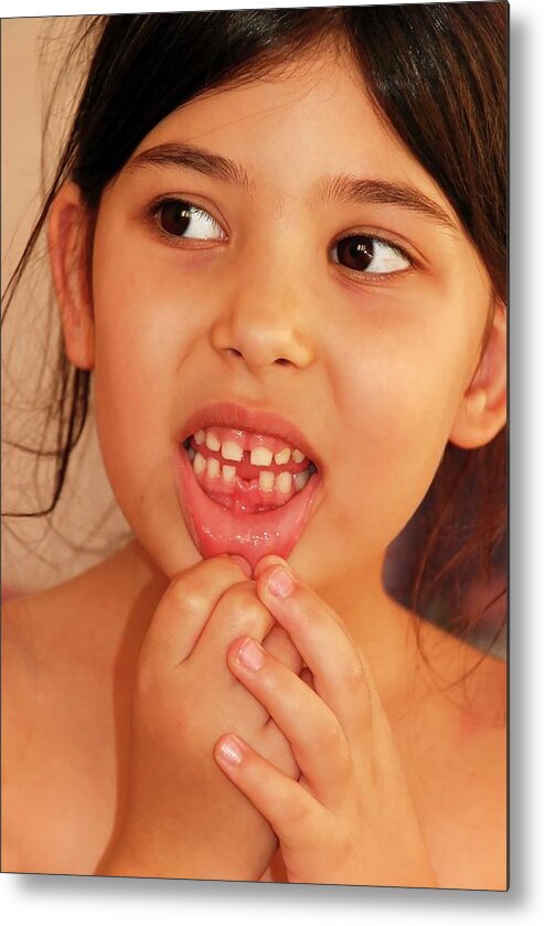 Ageing Metal Print featuring the photograph Girl With Missing Tooth by Photostock-israel