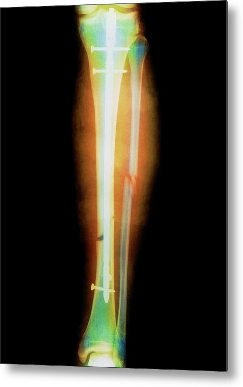 Tibia Metal Print featuring the photograph Pinned Broken Leg by Science Photo Library