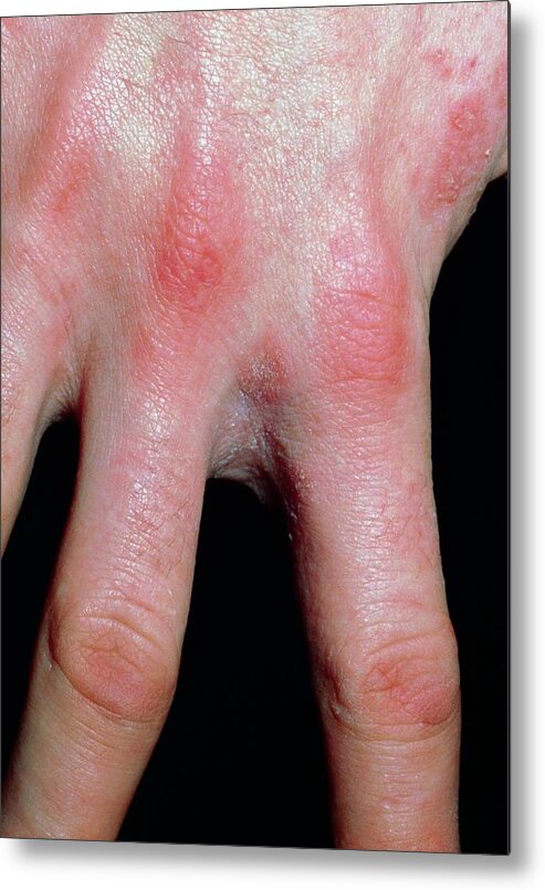 Scabies Infection On The Hand And Fingers Metal Print by Dr H.c.robinson /  Science Photo Library - Pixels