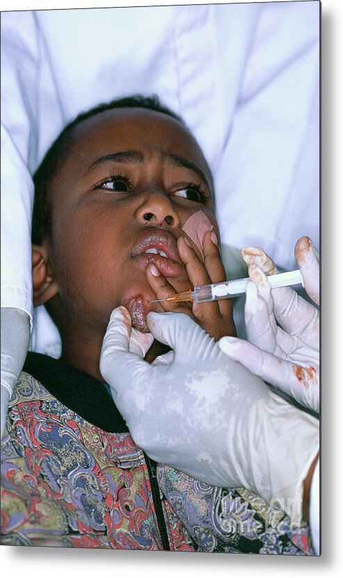Boy Metal Print featuring the photograph Leishmaniasis Diagnosis #1 by Andy Crump, Tdr, Who/science Photo Library