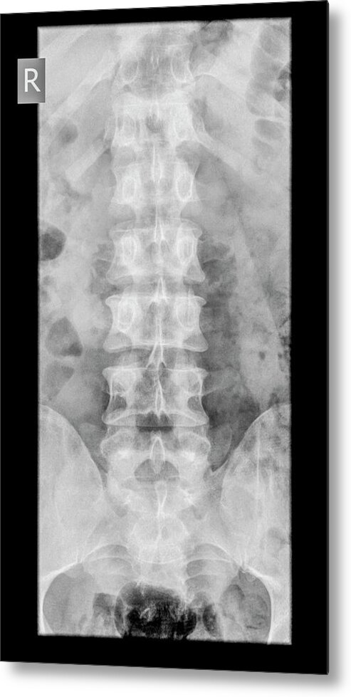 Adult Metal Print featuring the photograph Dens Fracture. Cervical Spine X-ray #3 by Photostock-israel