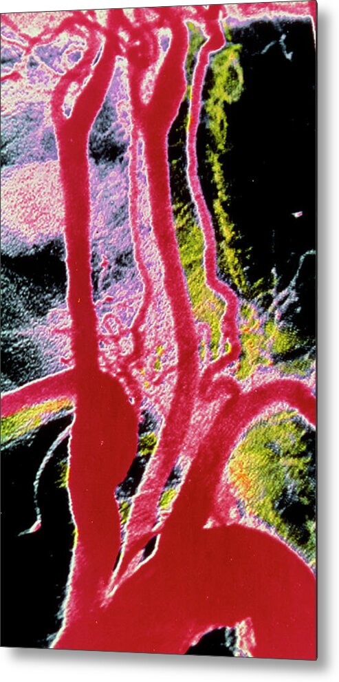 Arteriography Metal Print featuring the photograph Arteriograph Of Aortic Arch & Associated Arteries by Alain Pol, Ism/science Photo Library