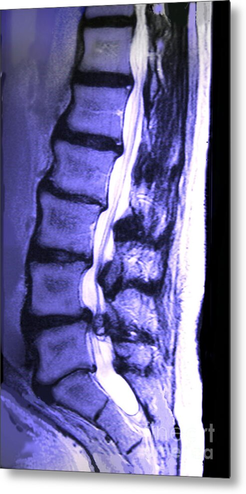 Arthritic Spine Metal Print featuring the photograph Arthritic Spine by Chris Bjornberg