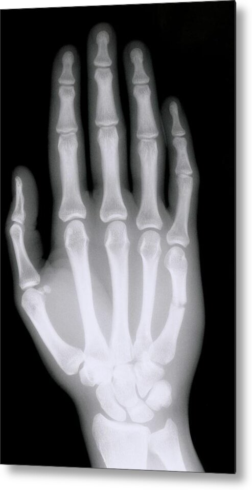 X-ray Metal Print featuring the photograph X-ray Of Broken Bone In Right Hand by Science Photo Library