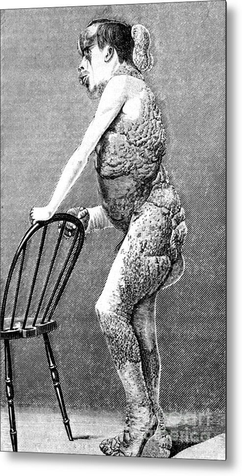 Science Metal Print featuring the photograph Joseph Merrick, The Elephant Man #3 by Science Source