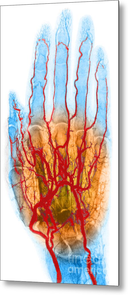 Angiogram Metal Print featuring the photograph Hand Arteriogram #3 by Science Source
