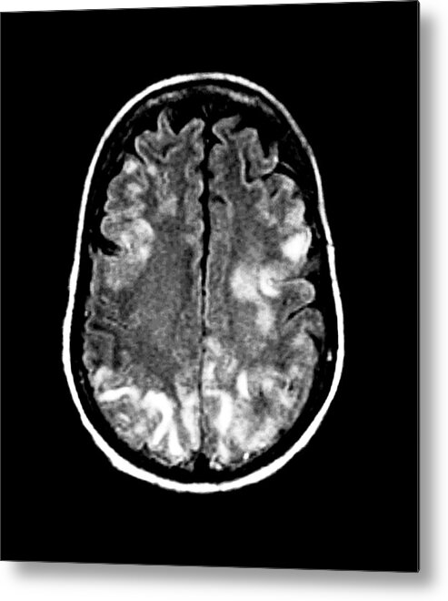 Nobody Metal Print featuring the photograph Brain In Toxic Encephalopathy #1 by Zephyr