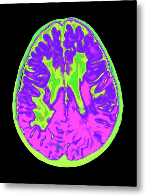 Multiple Sclerosis Metal Print featuring the photograph Coloured Mri Brain Scan Showing Multiple Sclerosis #1 by Mehau Kulyk/science Photo Library