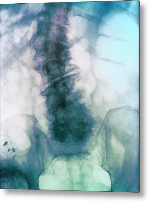 Scoliosis Metal Print featuring the photograph Diseased Spine #1 by Zephyr/science Photo Library
