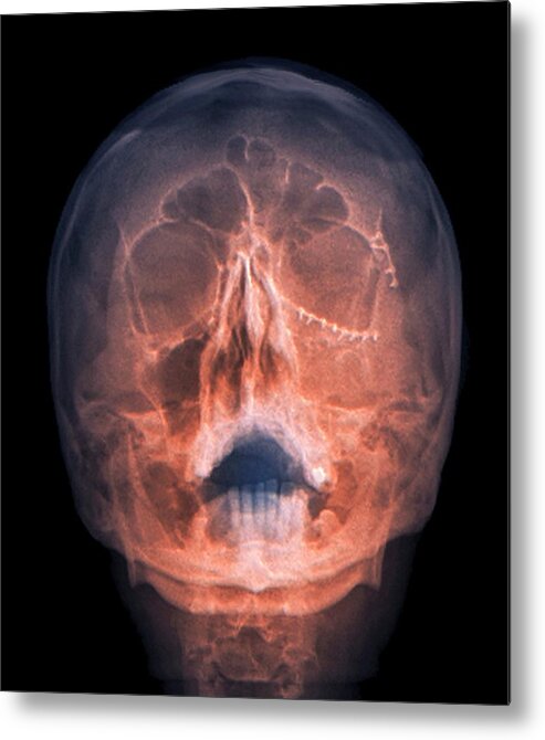 Coloured Metal Print featuring the photograph Fixed Skull Fractures #1 by Zephyr