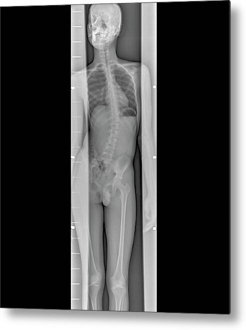 Whole Body Metal Print featuring the photograph Scoliosis Of The Spine #1 by Zephyr/science Photo Library