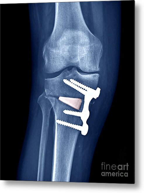 https://render.fineartamerica.com/images/rendered/default/metal-print/7/8/break/images-medium-5/3-knee-realignment-surgery-x-ray-zephyr.jpg