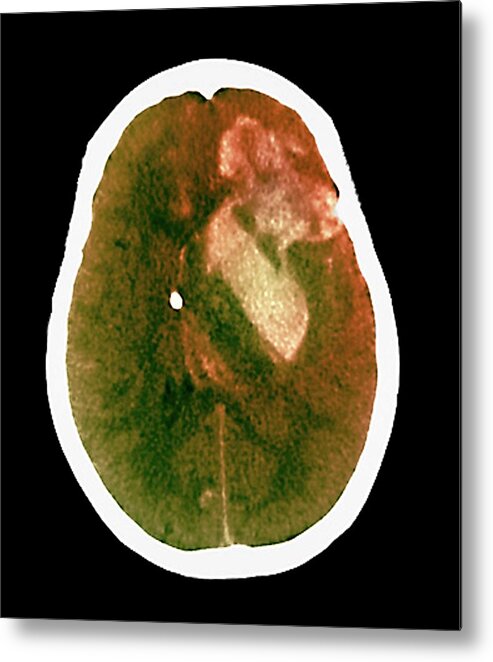 Colour Metal Print featuring the photograph Brain Haemorrhage From Aneurysm by Zephyr/science Photo Library
