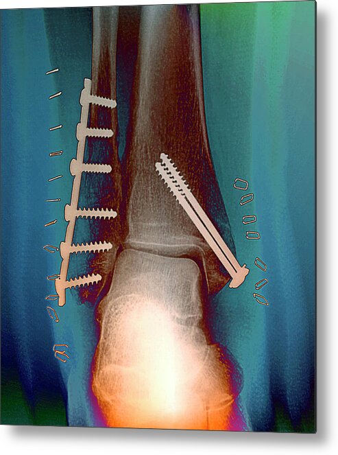 Break Metal Print featuring the photograph Pinned Ankle Fractures by Zephyr/science Photo Library