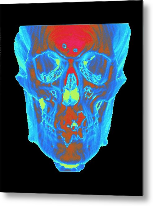 Ct Scan Metal Print featuring the photograph Skull by Mehau Kulyk/science Photo Library
