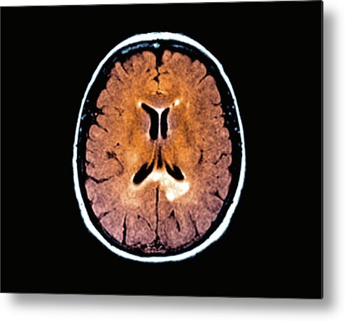 Multiple Sclerosis Metal Print featuring the photograph Multiple Sclerosis #4 by Zephyr/science Photo Library