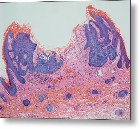 Abnormal Metal Print featuring the photograph Skin Cancer #6 by Steve Gschmeissner