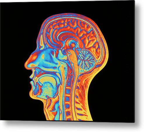 People Person Persons Metal Print featuring the photograph Coloured Mri Scan Of The Human Head (side View) by Pasieka