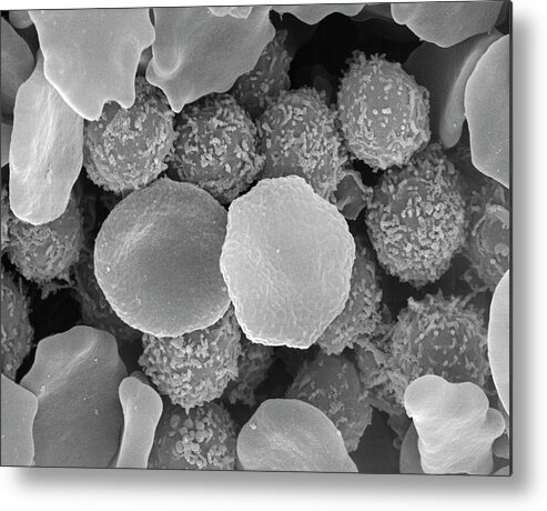 Abnormal Metal Print featuring the photograph Leukaemia by Steve Gschmeissner/science Photo Library