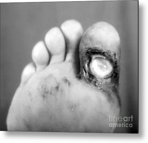 Bacterial Metal Print featuring the photograph Syphilis Ulcer by Science Source