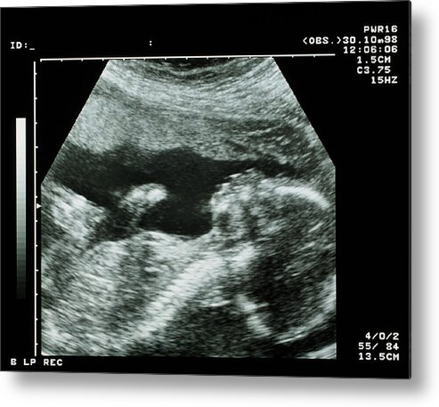 12 & 20 Week Pregnancy Ultrasound Baby Scan Print Photo Black Frame 