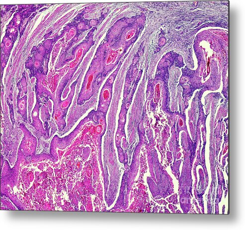 Anatomy Metal Print featuring the photograph Carcinoma Of The Oesophagus #1 by Nigel Downer/science Photo Library