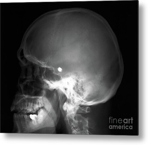 49 Year Old Metal Print featuring the photograph Aneurysm Treatment #4 by Zephyr/science Photo Library