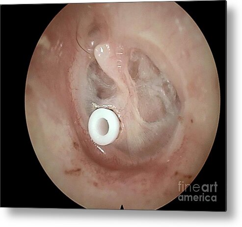 Grommet in the eardrum, otoscope view - Stock Image - C038/5777