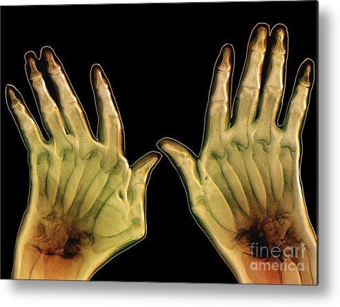 Rheumatoid Arthritis Metal Print featuring the photograph Arthritic Hands, X-ray #1 by Zephyr